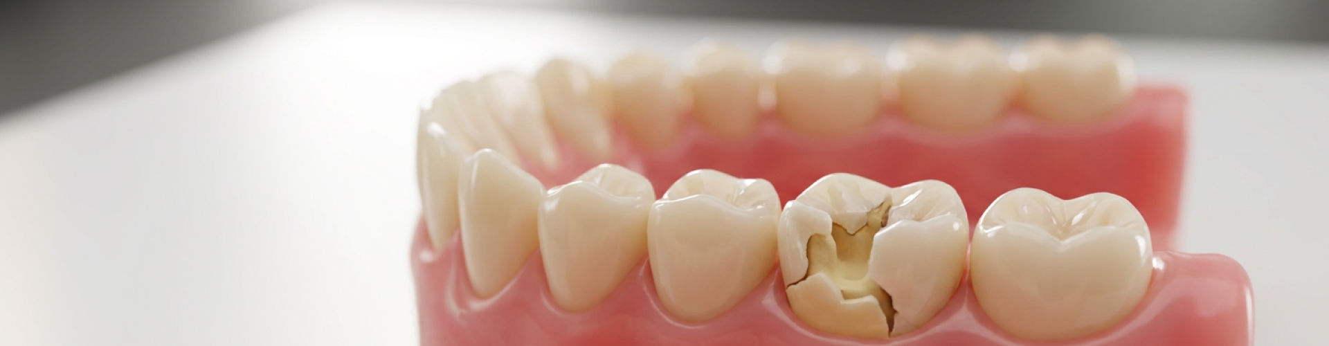Dental model showing a severely cracked molar with a large cavity, surrounded by healthy teeth and pink gums.